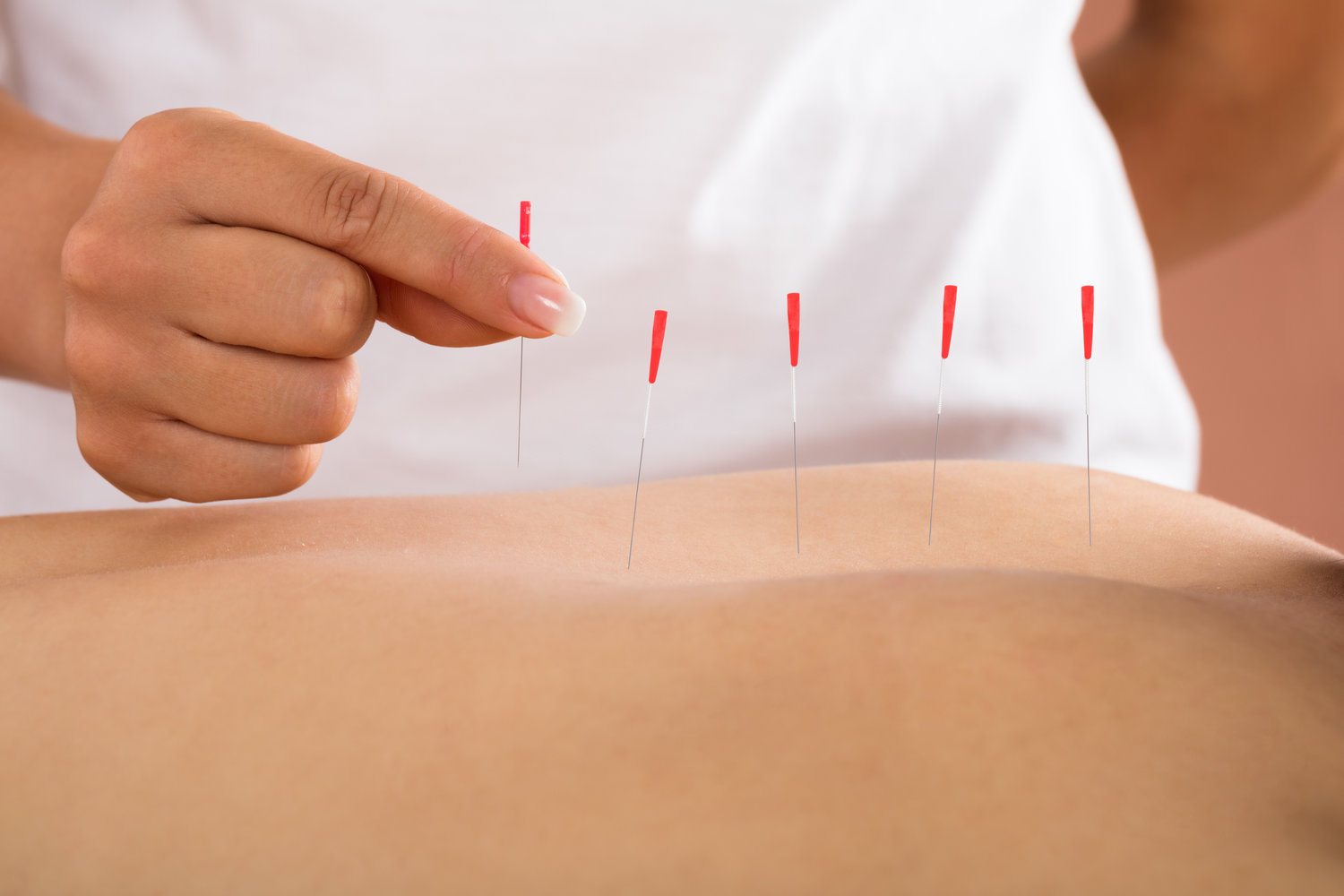 Potential Factors of Availing Dry Needling & Massage Brisbane