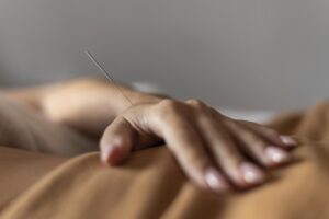 Acupuncture Therapy